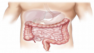 Leaky Gut Syndrome (LGS)