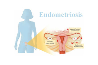 Endometriosis affects roughly 10% of reproductive age women